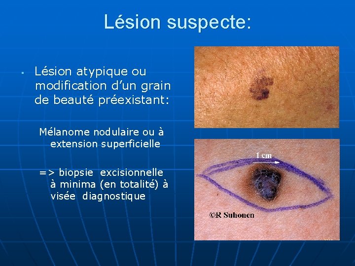 Lésion suspecte: § Lésion atypique ou modification d’un grain de beauté préexistant: Mélanome nodulaire