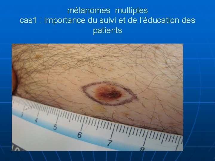 mélanomes multiples cas 1 : importance du suivi et de l’éducation des patients 