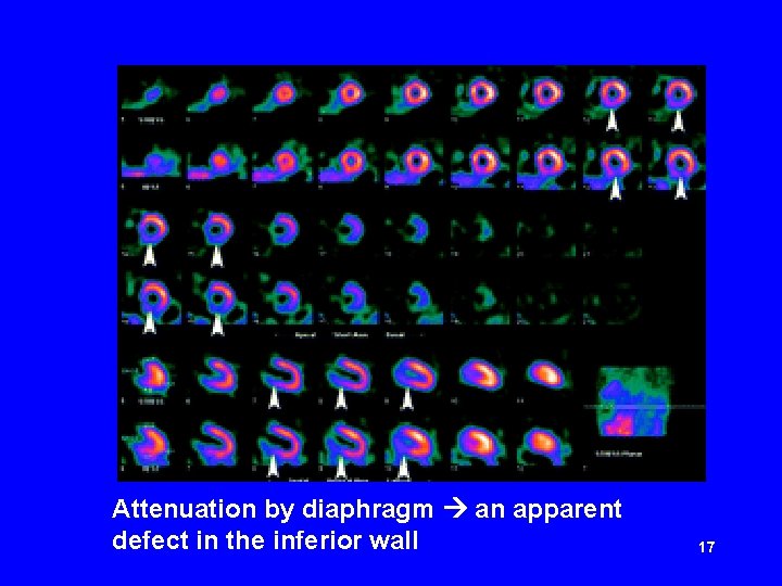 Attenuation by diaphragm an apparent defect in the inferior wall 17 