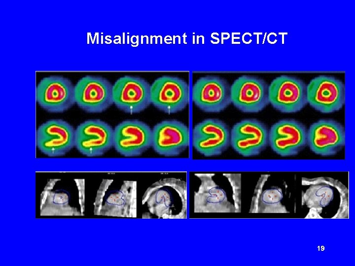 Misalignment in SPECT/CT 19 