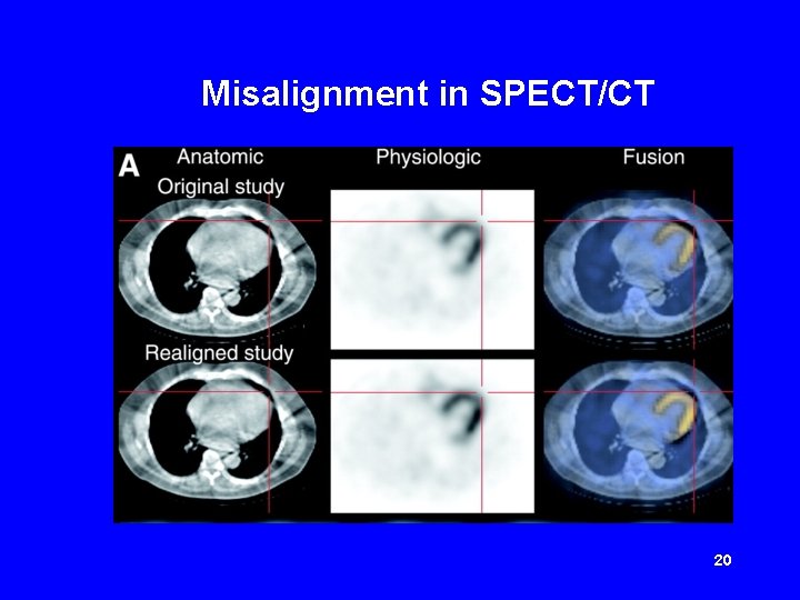 Misalignment in SPECT/CT 20 