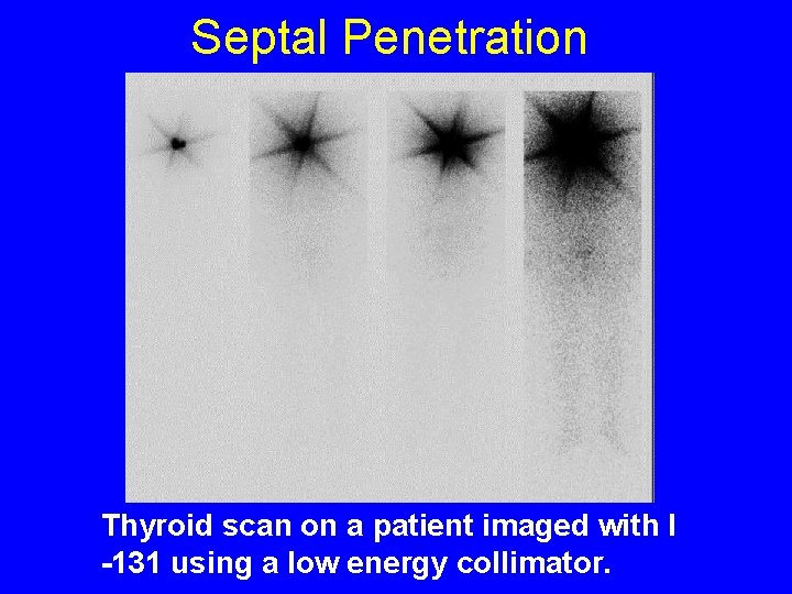 Septal Penetration Thyroid scan on a patient imaged with I -131 using a low