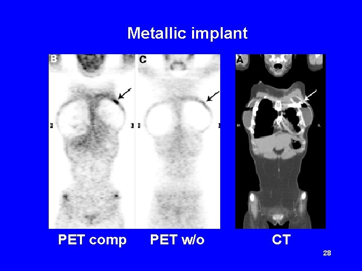 Metallic implant PET comp PET w/o CT 28 