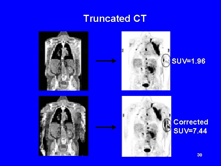 Truncated CT SUV=1. 96 Corrected SUV=7. 44 30 