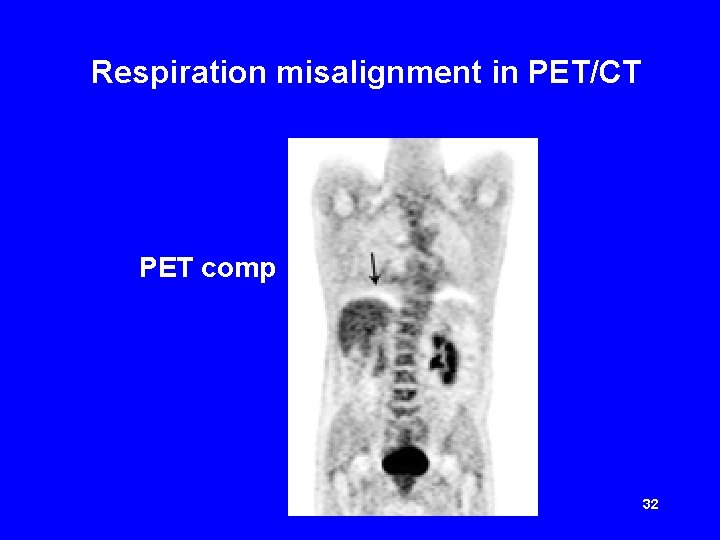 Respiration misalignment in PET/CT PET comp 32 