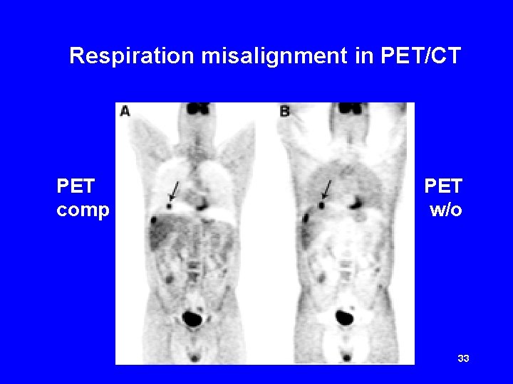 Respiration misalignment in PET/CT PET comp PET w/o 33 