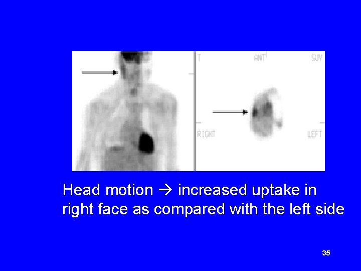 Head motion increased uptake in right face as compared with the left side 35