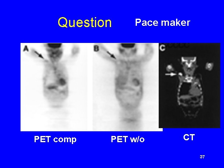 Question PET comp Pace maker PET w/o CT 37 