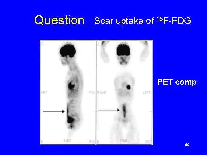 Question Scar uptake of 18 F-FDG PET comp 40 