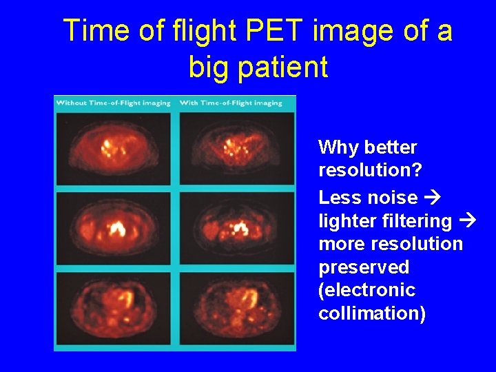 Time of flight PET image of a big patient Why better resolution? Less noise