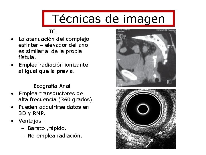 Técnicas de imagen TC • La atenuación del complejo esfínter – elevador del ano