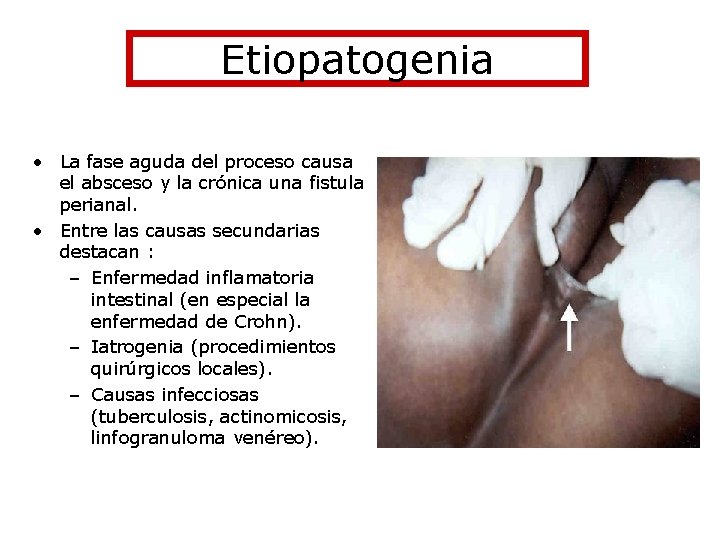 Etiopatogenia • La fase aguda del proceso causa el absceso y la crónica una