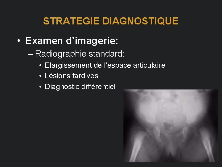 STRATEGIE DIAGNOSTIQUE • Examen d’imagerie: – Radiographie standard: • Elargissement de l’espace articulaire •