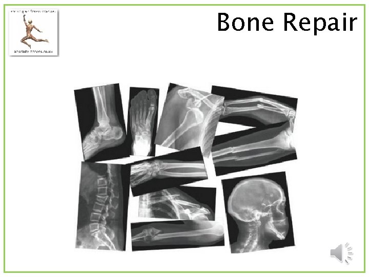 Bone Repair 