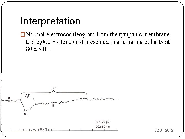 Interpretation � Normal electrocochleogram from the tympanic membrane to a 2, 000 Hz toneburst