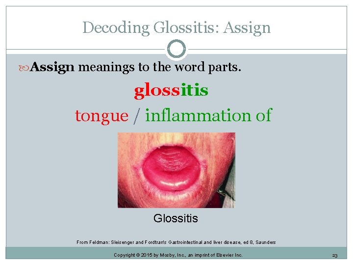 Decoding Glossitis: Assign meanings to the word parts. glossitis tongue / inflammation of Glossitis Decoding Glossitis: Assign meanings to the word parts. glossitis tongue / inflammation of Glossitis