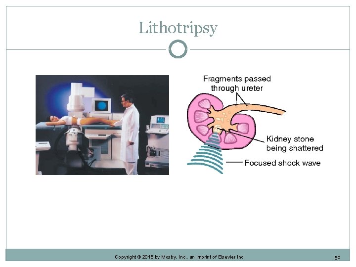 Lithotripsy Copyright © 2015 by Mosby, Inc. , an imprint of Elsevier Inc. 50 Lithotripsy Copyright © 2015 by Mosby, Inc. , an imprint of Elsevier Inc. 50