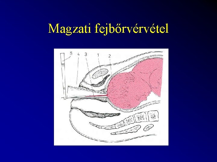 Magzati fejbőrvérvétel 