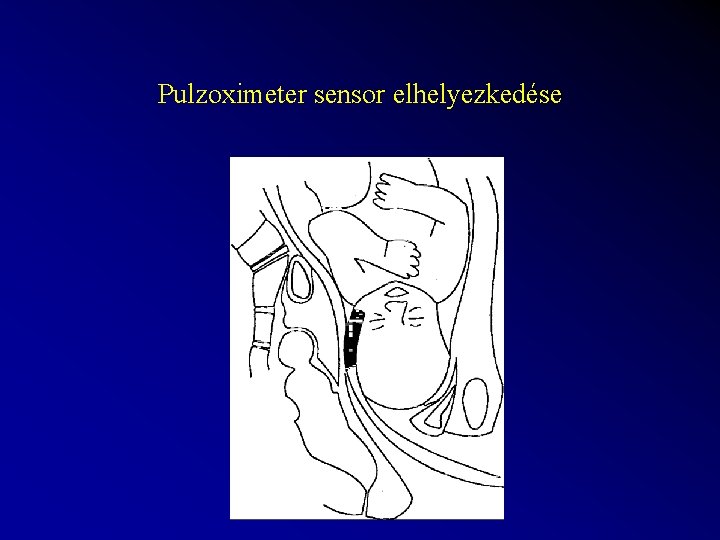 Pulzoximeter sensor elhelyezkedése 