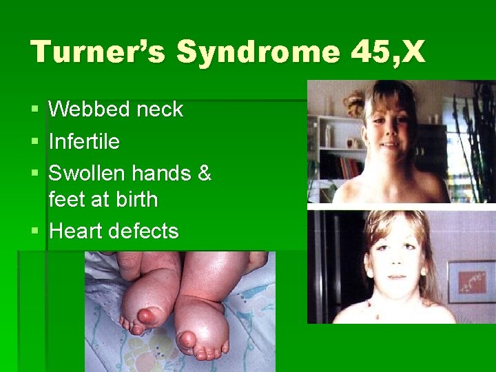 Turner’s Syndrome 45, X § § § Webbed neck Infertile Swollen hands & feet