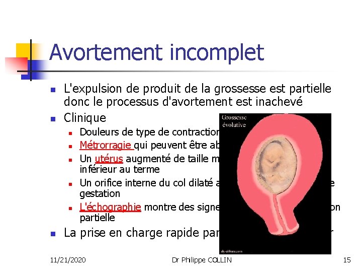 Avortement incomplet n n L'expulsion de produit de la grossesse est partielle donc le