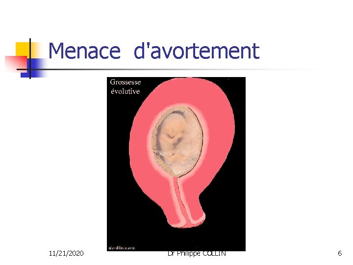 Menace d'avortement 11/21/2020 Dr Philippe COLLIN 6 