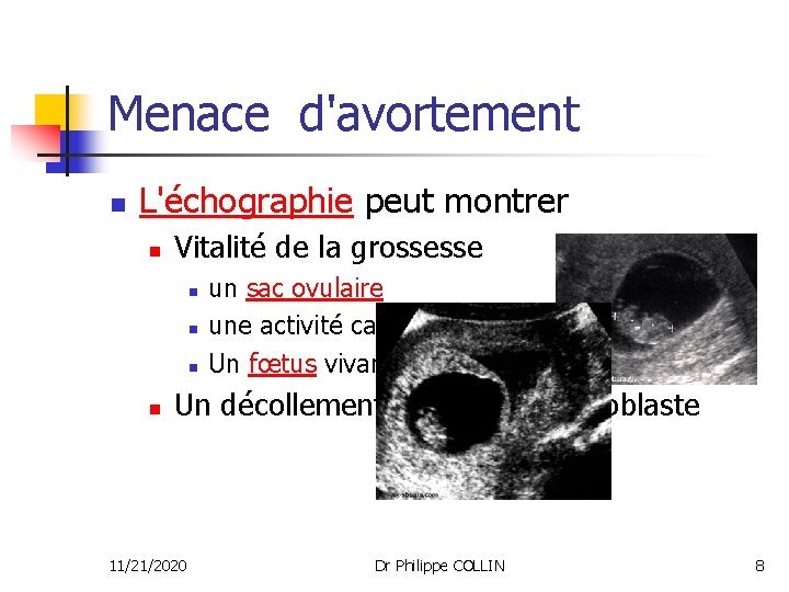 Menace d'avortement n L'échographie peut montrer n Vitalité de la grossesse n n un