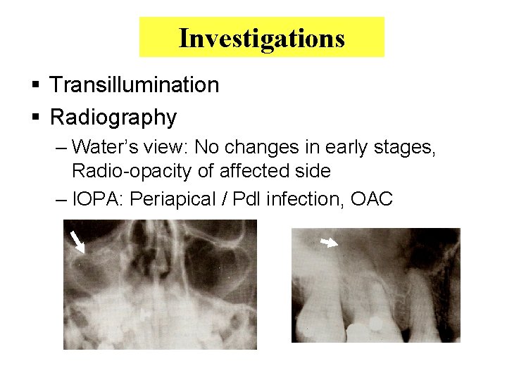 Investigations § Transillumination § Radiography – Water’s view: No changes in early stages, Radio-opacity