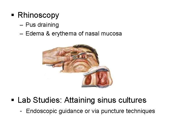 § Rhinoscopy – Pus draining – Edema & erythema of nasal mucosa § Lab