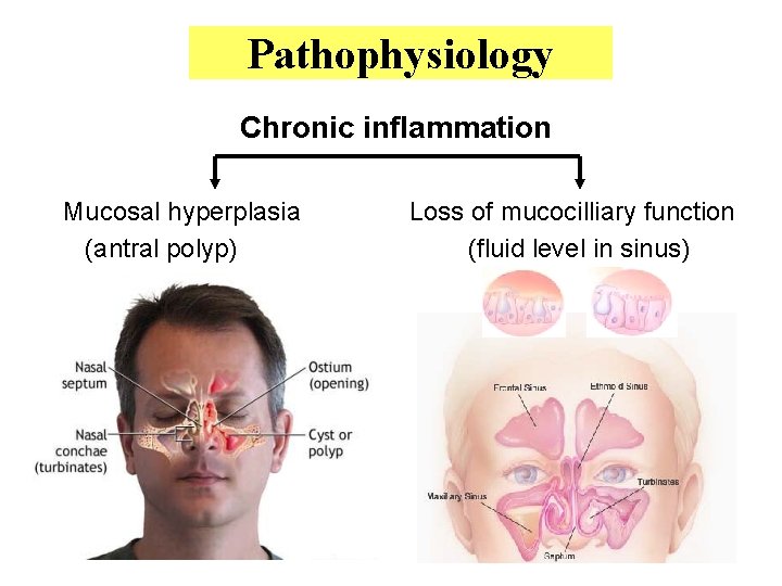 Pathophysiology Chronic inflammation Mucosal hyperplasia Loss of mucocilliary function (antral polyp) (fluid level in