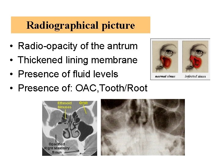 Radiographical picture • • Radio-opacity of the antrum Thickened lining membrane Presence of fluid