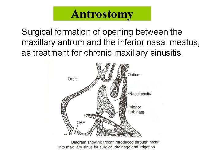 Antrostomy Surgical formation of opening between the maxillary antrum and the inferior nasal meatus,
