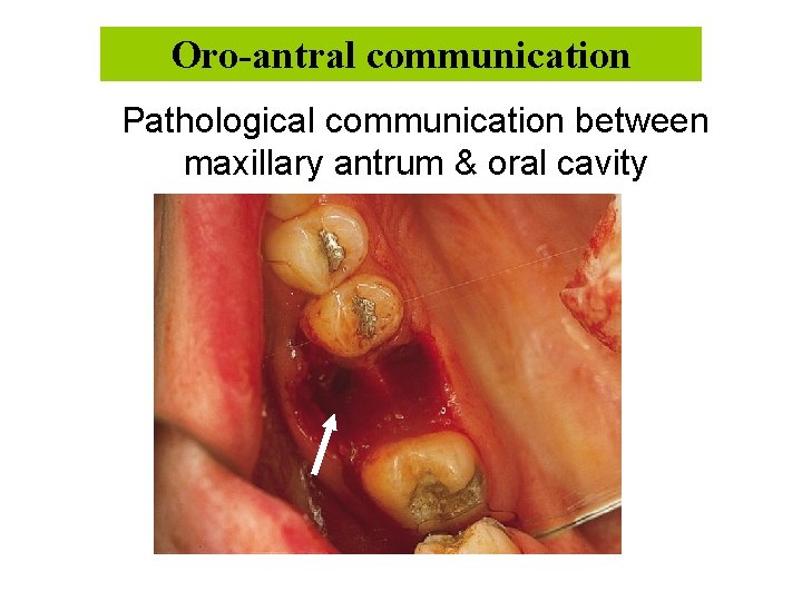 Oro-antral communication Pathological communication between maxillary antrum & oral cavity 