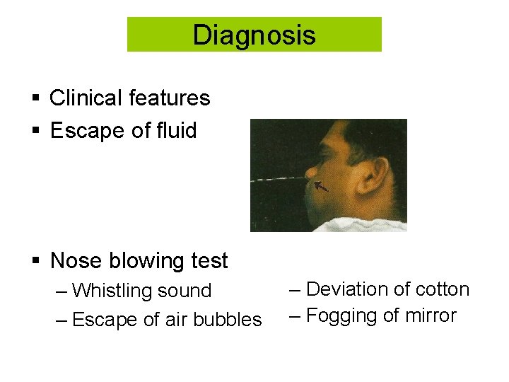 Diagnosis § Clinical features § Escape of fluid § Nose blowing test – Whistling