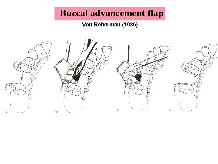 Buccal advancement flap Von Reherman (1936) 