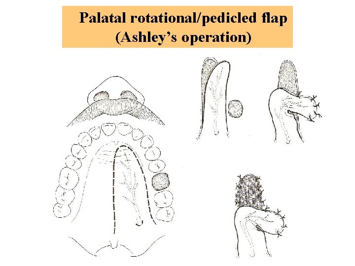 Palatal rotational/pedicled flap (Ashley’s operation) 