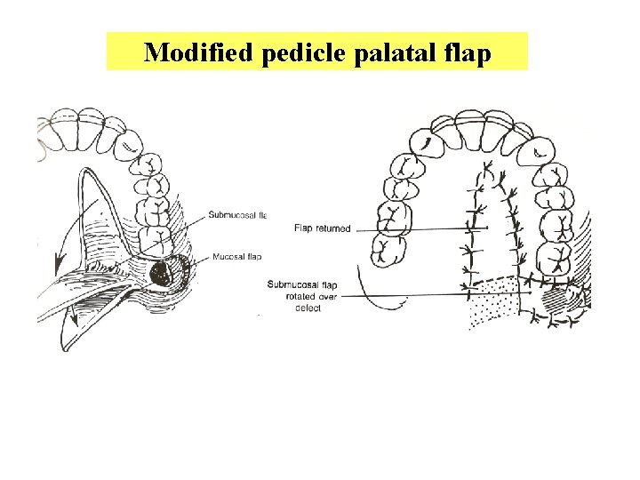 Modified pedicle palatal flap 
