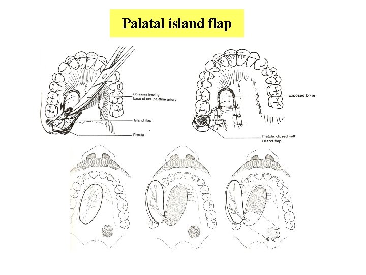 Palatal island flap 