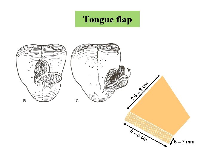 2. 5 – 3 cm Tongue flap 5– 6 c m 5 – 7
