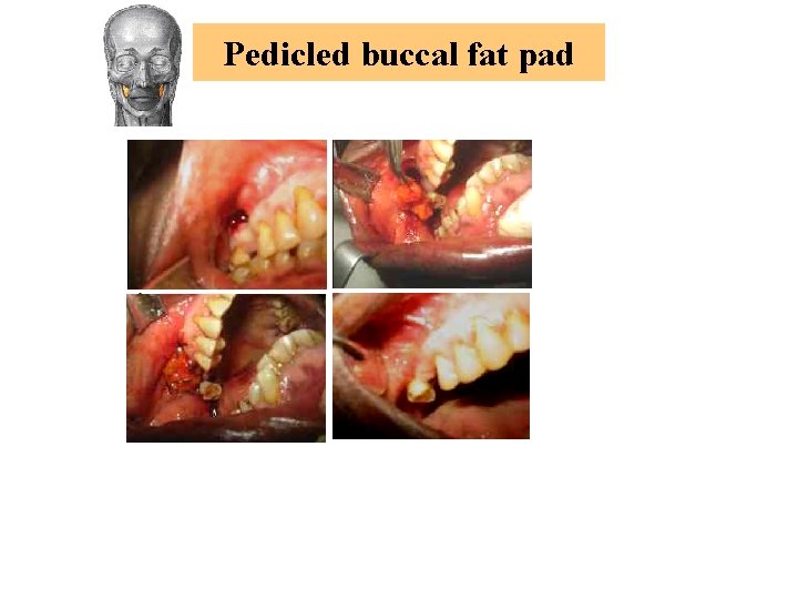 Pedicled buccal fat pad 