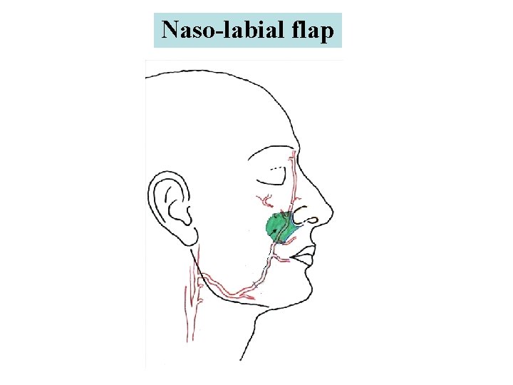 Naso-labial flap 