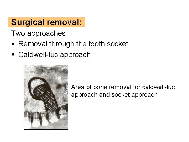 Surgical removal: Two approaches § Removal through the tooth socket § Caldwell-luc approach Area