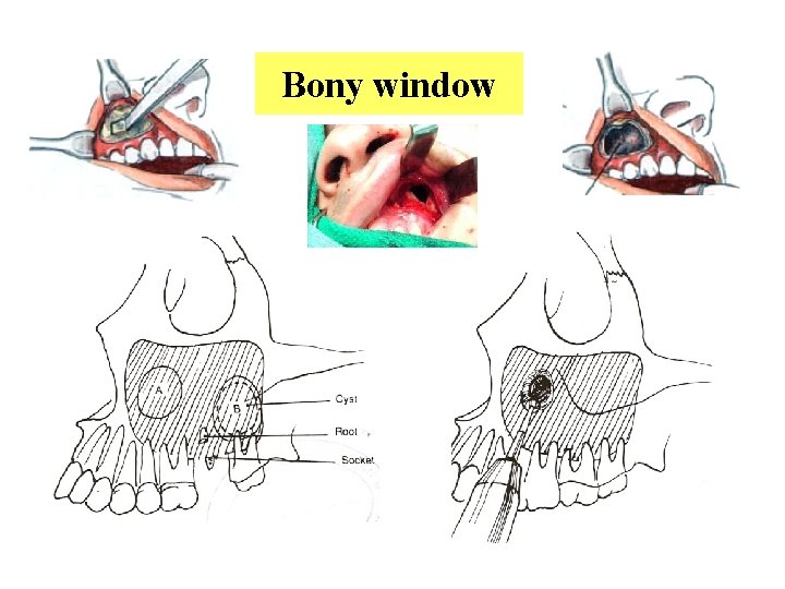 Bony window 