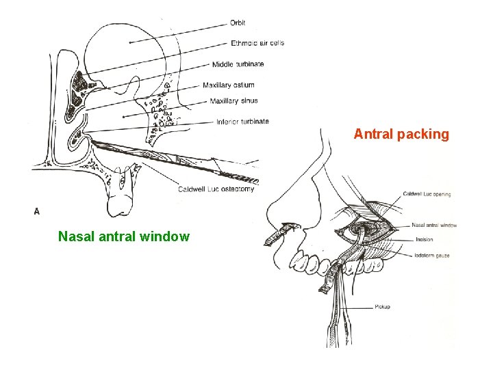 Antral packing Nasal antral window 