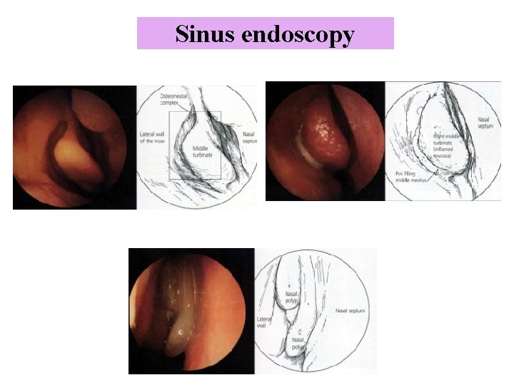 Sinus endoscopy 