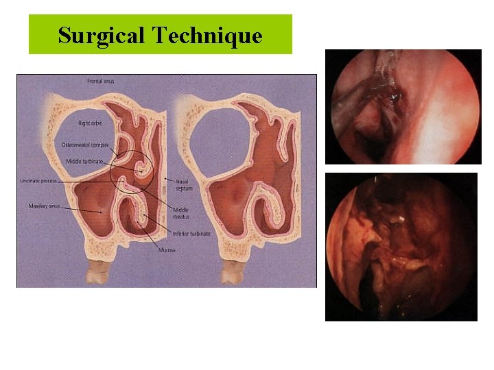 Surgical Technique 