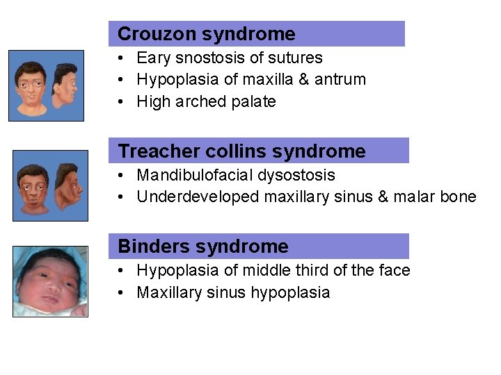 Crouzon syndrome • Eary snostosis of sutures • Hypoplasia of maxilla & antrum •