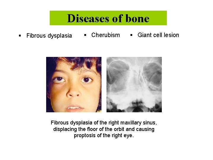 Diseases of bone § Fibrous dysplasia § Cherubism § Giant cell lesion Fibrous dysplasia
