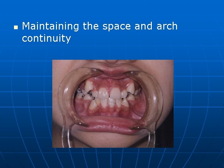 n Maintaining the space and arch continuity 