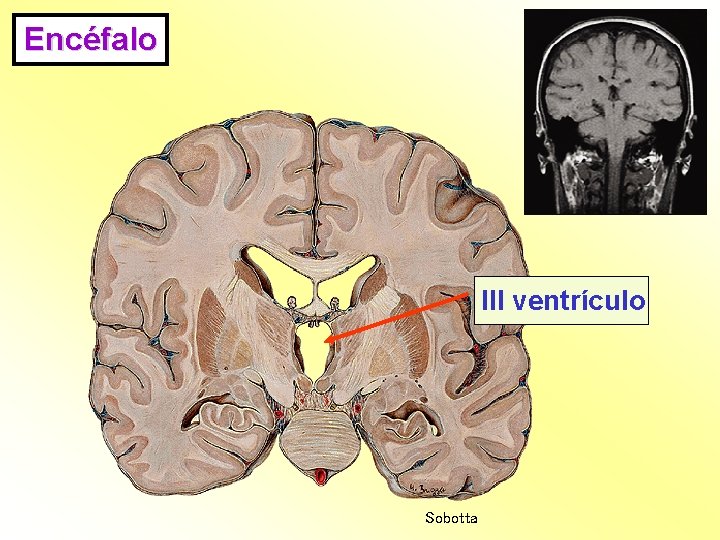 Encéfalo III ventrículo Sobotta 